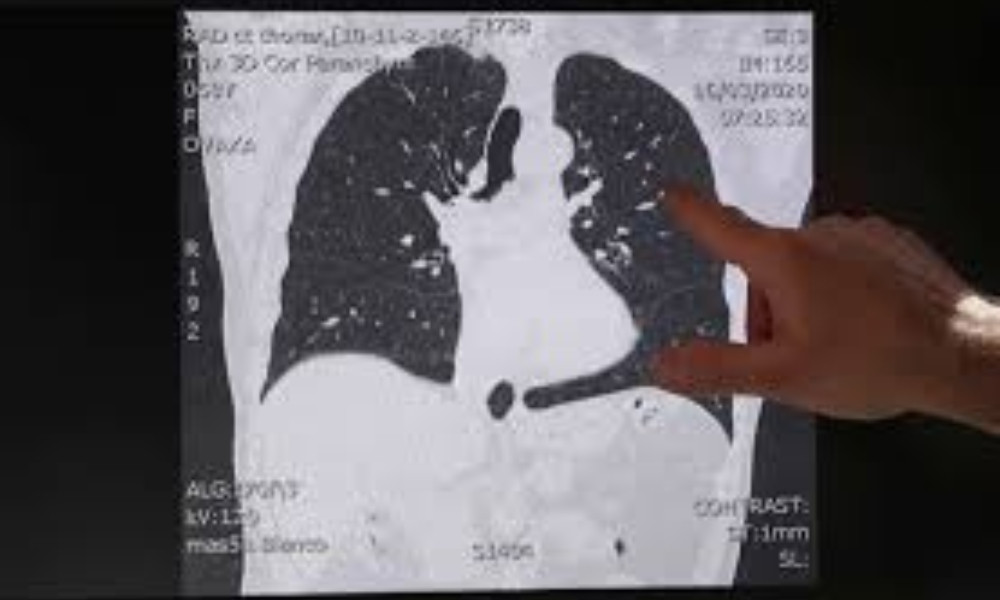 ফুসফুসের ক্যানসার নিয়ে যতসব ভুল ধারণা, জেনে নিন সত্য