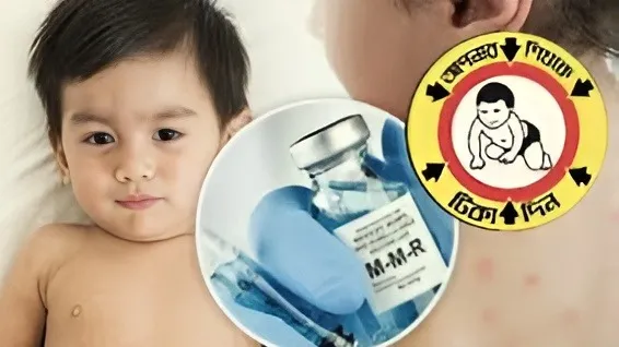 এগিয়ে আনা হয়েছে দেশব্যাপী হামের টিকাদান কর্মসূচি, শুরু ২০ এপ্রিল