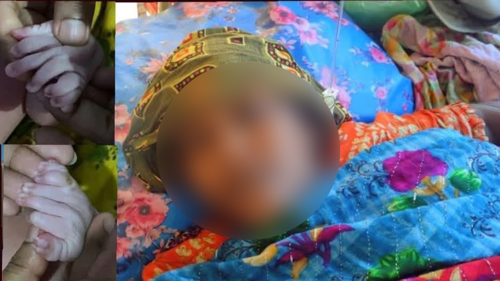 ৩০ আঙুল নিয়ে শিশুর জন্ম, এলাকায় চাঞ্চল্য